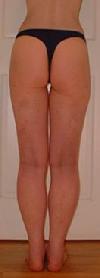 before after liposuction calves ankles