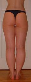 before agter liposuction thighs