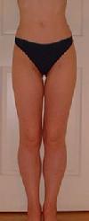 before after liposuction thighs