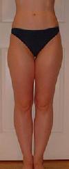 before after liposuction thighs