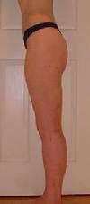 before after liposuction thighs