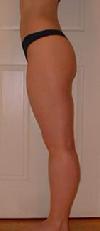 before after liposuction thighs