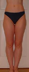 before after liposuction calves ankles