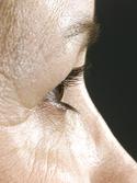 before after eyelid surgery blepharoplasty