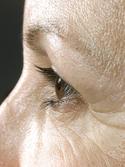 before after eyelid surgery blepharoplasty
