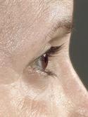 before after eyelid surgery blepharoplasty