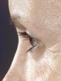 before after eyelid surgery blepharoplasty