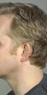 before after ear pinning otoplasty
