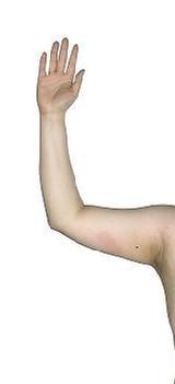 before after liposuction arms