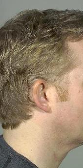 before after ear pinning otoplasty