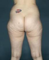 before after liposuction thighs