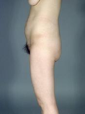 before after liposuction thighs