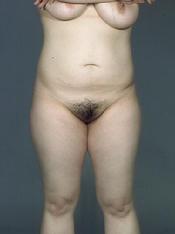 before after liposuction thighs