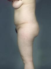 before after liposuction thighs
