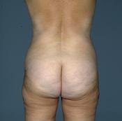 before after liposuction thighs