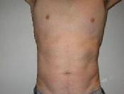before after liposuction abdomen flanks male