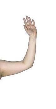before after liposuction arms