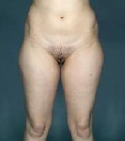 before after liposuction thighs