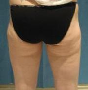 before after liposuction thighs