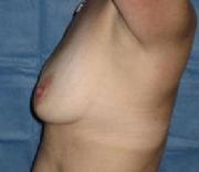before after breast augmentation