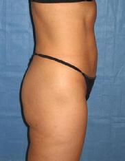 before after liposuction abdomen flanks