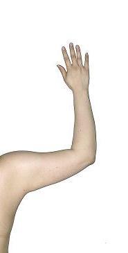 before after liposuction arms
