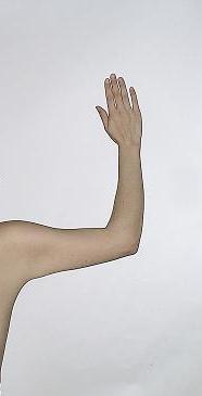 before after liposuction arms