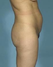 before after liposuction abdomen flanks