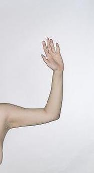 before after liposuction arms