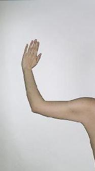 before after liposuction arms