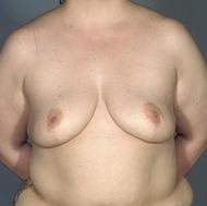 before after breast reduction