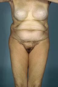 before after tummy tuck abdominoplasty