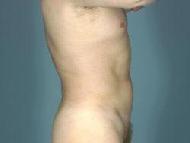 before after liposuction male abdomen flanks