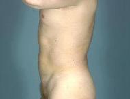 before after liposuction male abdomen flanks