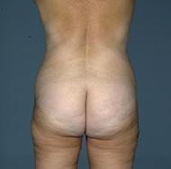before after liposuction abdomen flanks