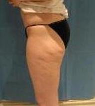 before after liposuction thighs