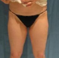 before after liposuction thighs
