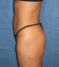 before after liposuction abdomen flanks