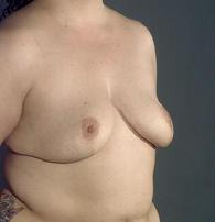 before after breast reduction