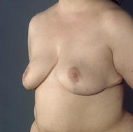 before after breast reduction