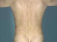 before after liposuction male abdomen flanks