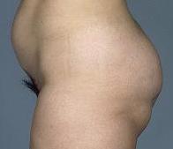 before after fat grafting body