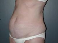 before after tummy tuck abdominoplasty