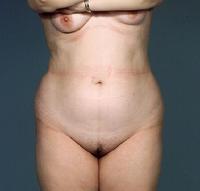 before after liposuction abdomen flanks