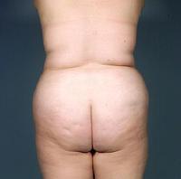 before after liposuction abdomen flanks