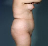 before after liposuction abdomen flanks