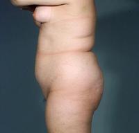 before after liposuction abdomen flanks