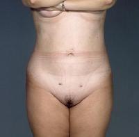 before after liposuction abdomen flanks