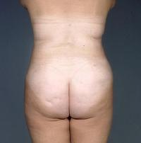 before after liposuction abdomen flanks