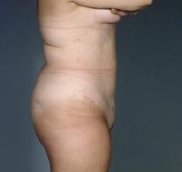 before after liposuction abdomen flanks